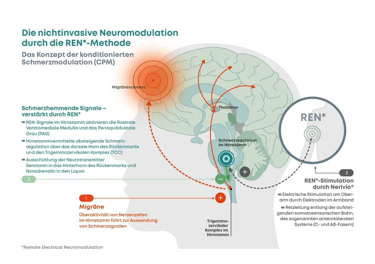 Infografik zur nichtinvasiven Neuromodulation (REN-Methode)